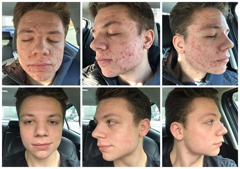 accutane while dating